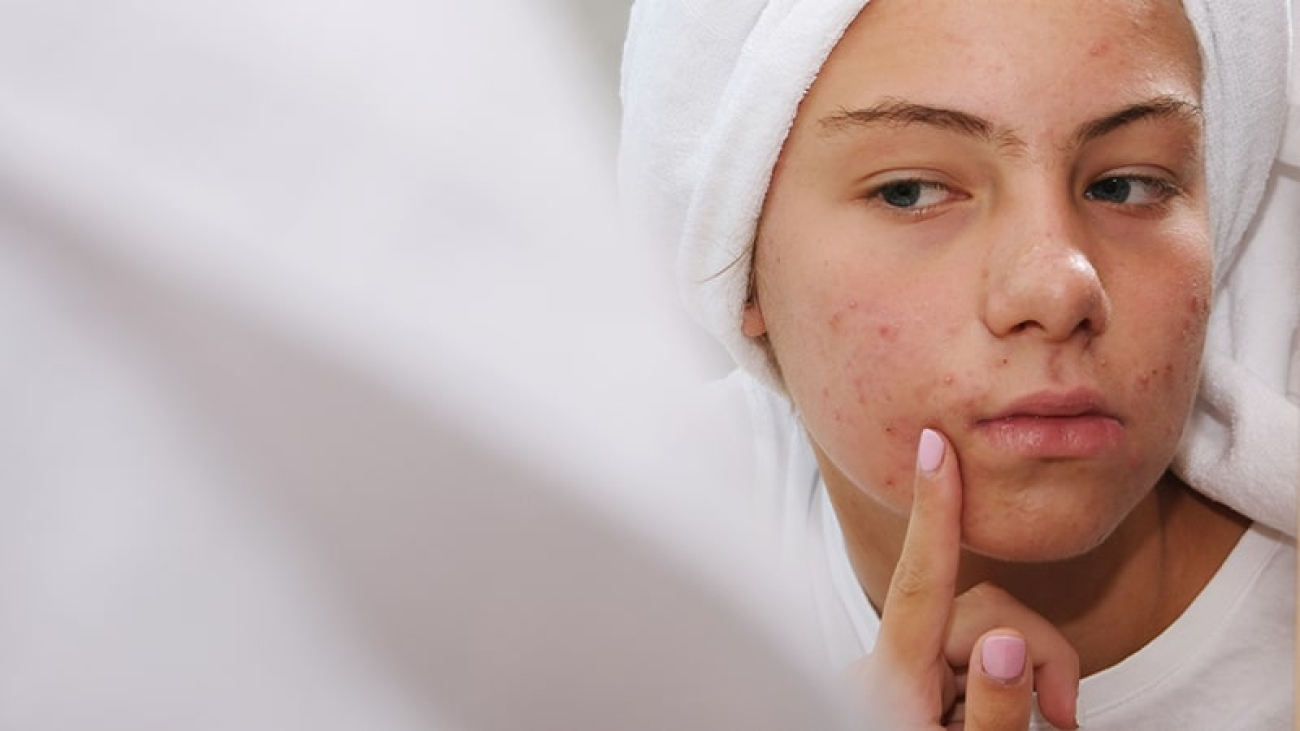 adolescente-acne-min