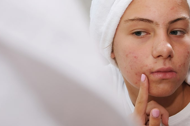 adolescente-acne-min